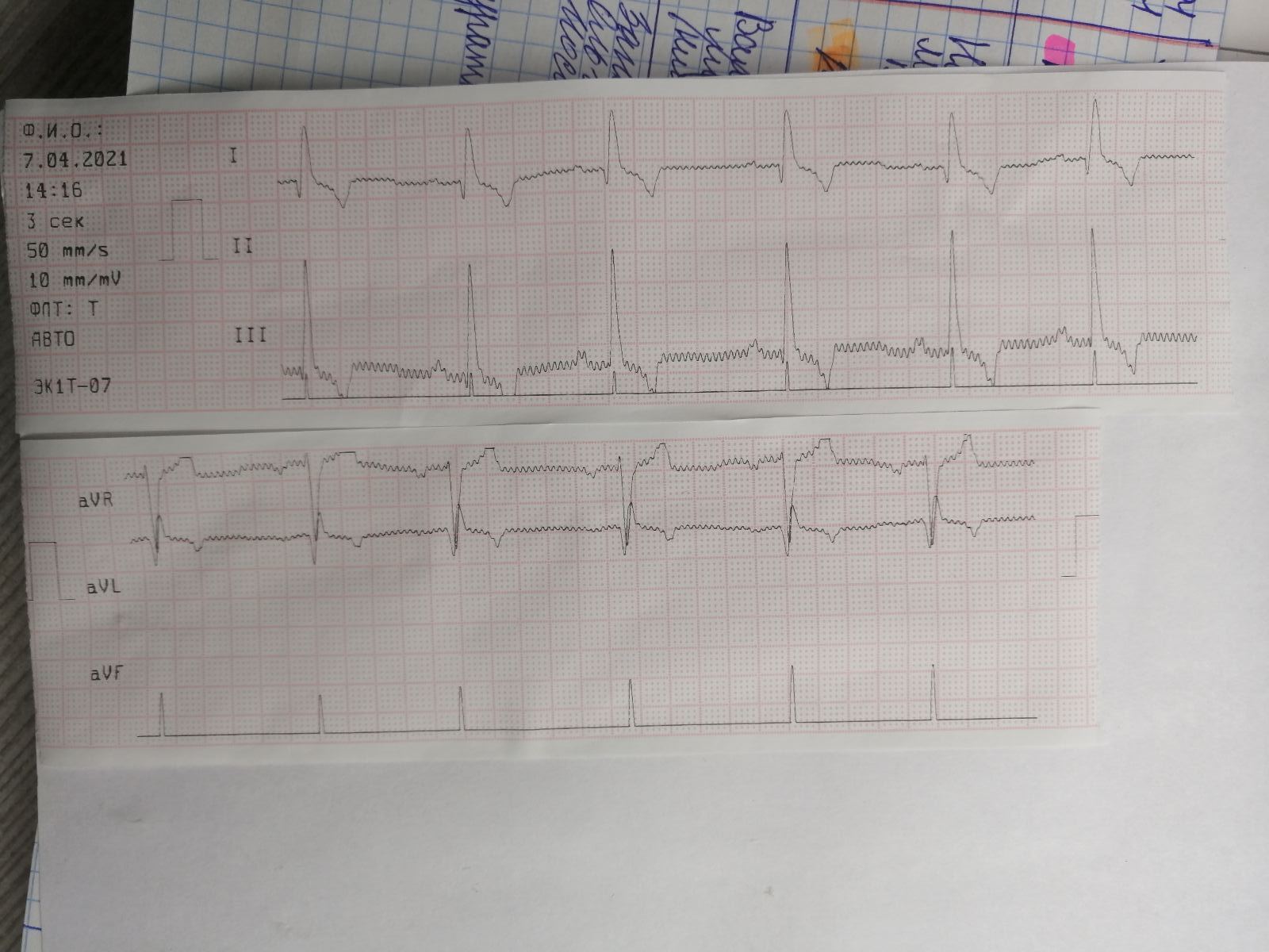 EKG2